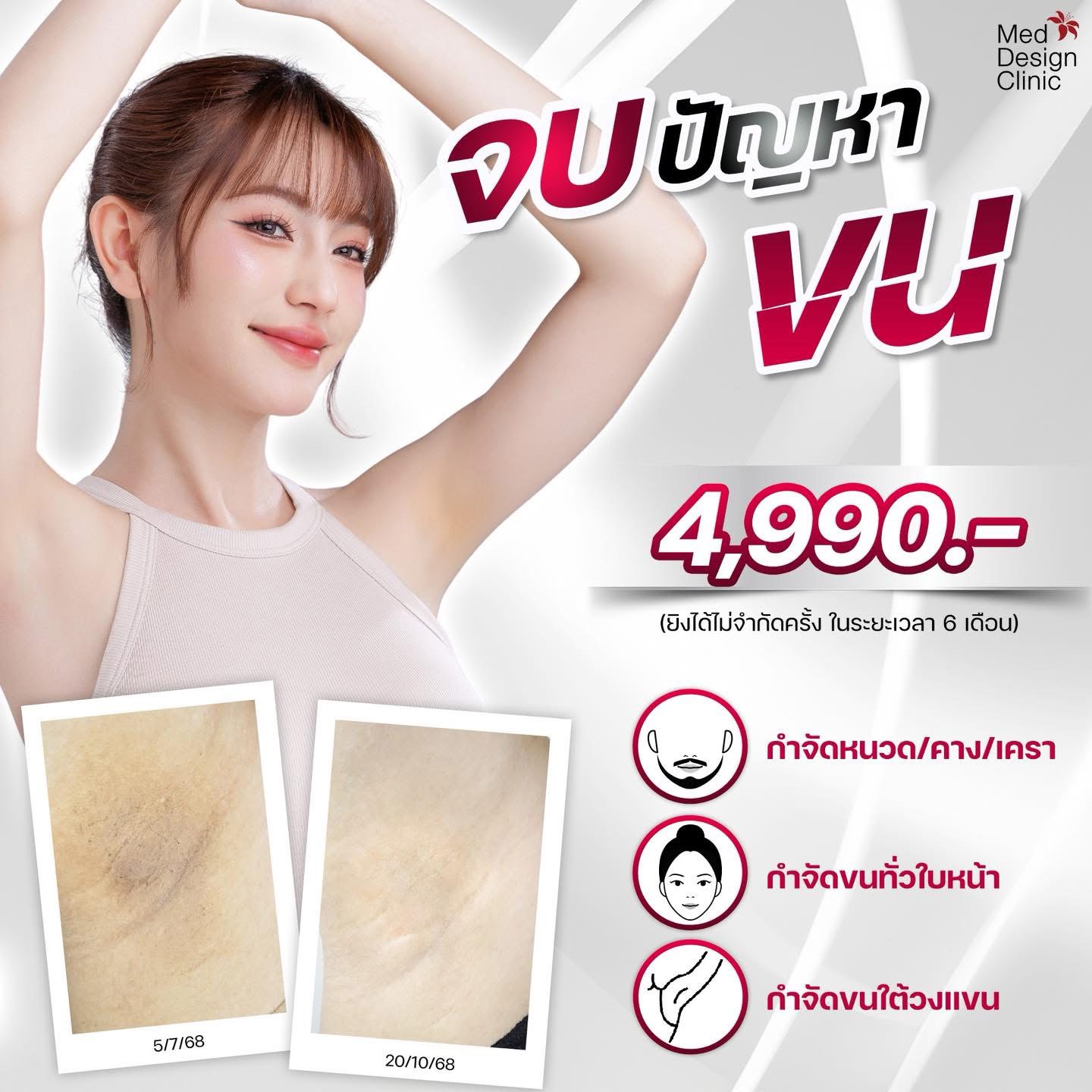 กำจัดขน
